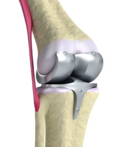 cirugia-protesis-de-rodilla-guadalajara-mexico.jpg