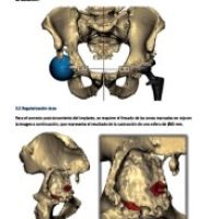 implantacion